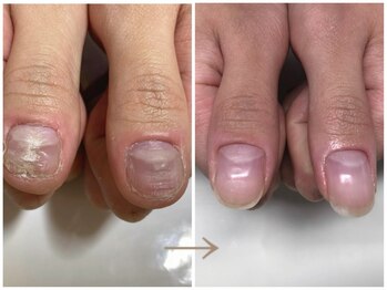 ネイルサロンカリプソ(Nail Salon Calypso 2)/メンズ☆お試し深爪矯正16500円