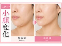 イトウサロン(ITO SALON)の雰囲気（フェイスラインすっきり♪施術後の変化を実感◎）