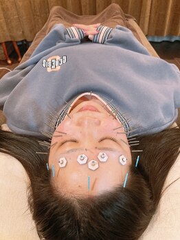 アキュティ 吉祥寺(Acuty)/小顔美容鍼+美容灸