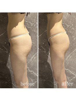 インディバ 六本木/【下半身痩身】 before→after