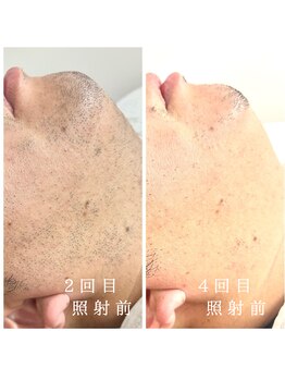 ランプ(LAMP)/~ハイブリッドヒゲ脱毛~