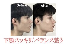 ラプリ 盛岡店(Raplit)/隆鼻＋輪郭矯正40分10回