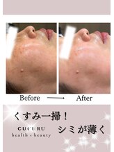 ククルヘルスビューティー(CUCURU health×beauty)/大人気のプラピールで発光肌