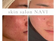 ナビ(NAVI)/肌質改善・ニキビケア・跡