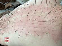 はりきゅう和 ルート鍼灸院/体のメンテナンス