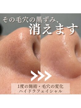 まつげ屋リュ( Ly)/ハイドラフェイシャル