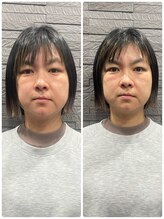 長寿鍼灸院 長寿整骨院/ハリネズミ女優美容鍼効果★