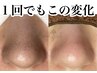 【黒ずみ毛穴.詰まり毛穴】いちご鼻、ポツポツ毛穴はこのコース！