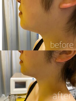 ミミーモリオカ(MiMiy MORIOKA)/あご下小顔マシン施術1回