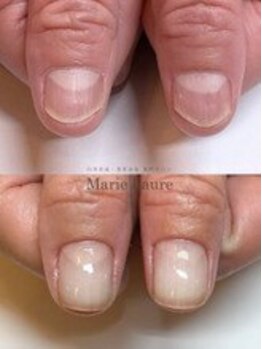 マリーロール 梅田店(Marie Laure)/自爪育成/深爪矯正/ネイルケア