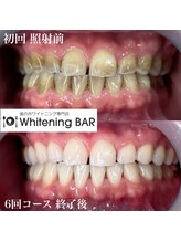 ホワイトニングバー アティ郡山店/6回コース終了ビフォーアフター