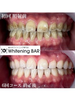 ホワイトニングバー アティ郡山店/6回コース終了ビフォーアフター