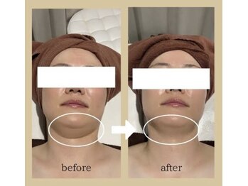 サロン ド プリヴェ(Salon de PRIVE)/40代からのたるみケア必見!