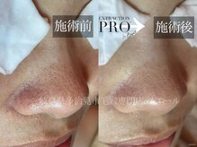 エール(aile)/鼻の毛穴綺麗になれます！