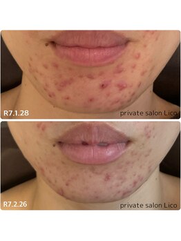 リコ(Lico)/ニキビケア