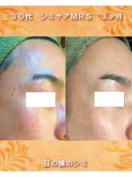 ナイア(naia)/アクアヴィーナス使用症例