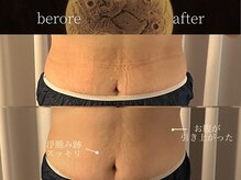 リムーン(REMOON.)/施術後の効果★