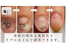 ティアラネイル(tiaranail)/リプロネイル深爪矯正コース