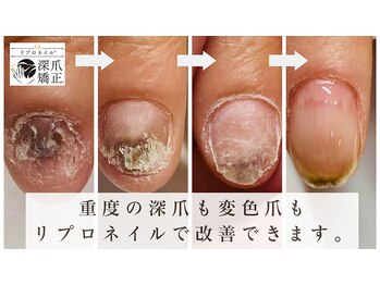 ティアラネイル(tiaranail)/リプロネイル深爪矯正コース