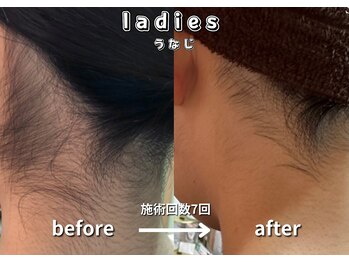 キュー(cue)/【レディース】「うなじ脱毛」