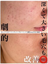 アリュール(ALLURE)/光ハイドロピーリングの施術効果