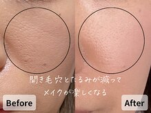 バタフライ 平塚店(Butterfly)/40代のたるみ開き毛穴に劇的変化