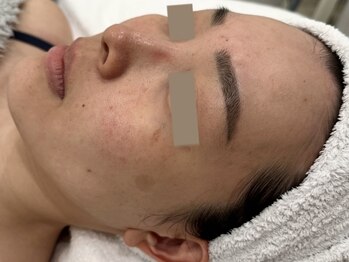 ウェクシー 名古屋駅前店(WECXII)/赤みと乾燥で悩んでいました