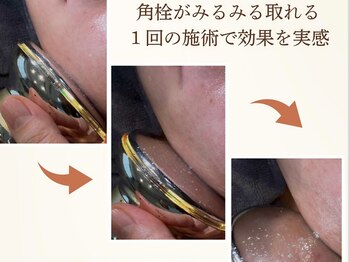 カリアンヌ/毛穴ケア・毛穴角栓除去
