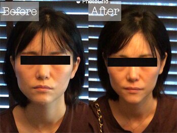 パウザ(PAUSA)/小顔矯正＋顔骨造フェイシャル