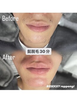 リゼクシー INTERNATIONAL麻布十番 六本木(RESEXXY)/髭脱毛30分コース