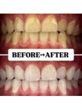 ホワイトニングサロン 宝塚/Before&After美白ホワイトニング