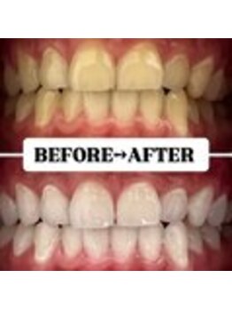 ホワイトニングサロン 宝塚/Before&After美白ホワイトニング