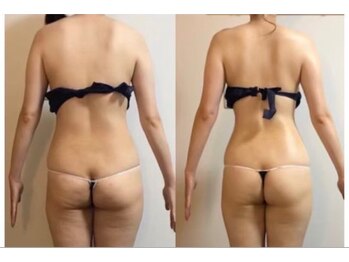 アーク(ARC)/上半身60分 before/after