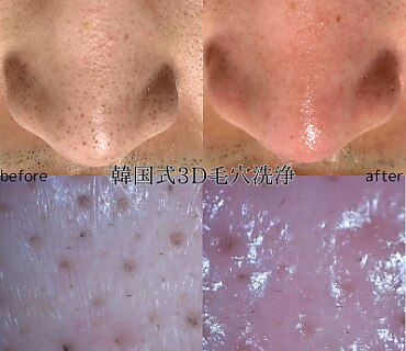 韓国式3D毛穴洗浄☆HARIKANジェル 韓国式3D毛穴洗浄☆HARIKANジェル大人の上質 3R 韓国式3D毛穴