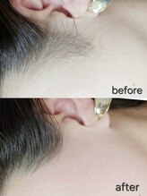 アール(R)/部分wax脱毛(もみあげ)