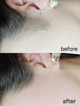 アール(R)/部分wax脱毛(もみあげ)