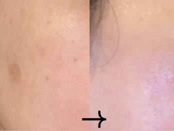 サロン ドロップ 上小田井(Salon drop)/「シミ改善」