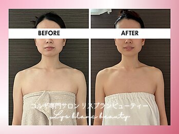 リス ブラン ビューティー(Lys blanc beauty)/90分コルギBefore×After