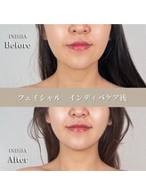 術後の女神 大阪本町店/ダウンタイムケア・インディバ