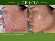 ミー(Me)の雰囲気(《ビオフィート》ニキビ、毛穴、酸素供給、血流促進、くすみ)
