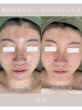 サロンドジェシカ(salon de Jessica)/プラズマフェイシャル
