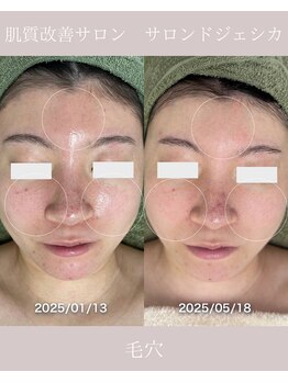 サロンドジェシカ(salon de Jessica)/プラズマフェイシャル