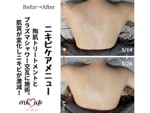 ミーアップ(Me up)/背中ニキビ