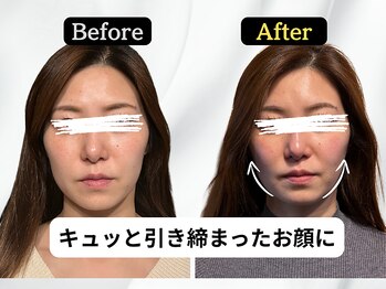 ハリユナイテッド 原宿鍼灸 整体院(HALI UNITED)/キュッと引き締まった小顔に!