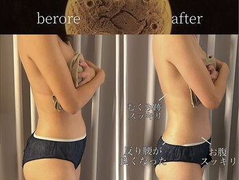 リムーン(REMOON.)/施術後の効果★