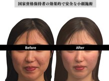 アロエベル(aloe Belle)/Before After（1回施術）