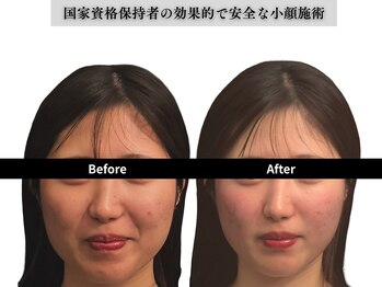 アロエベル(aloe Belle)/Before After（1回施術）