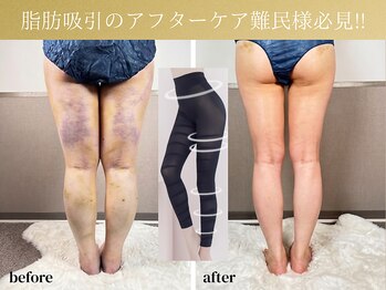 サロン ド プラージュの写真/《術後&むくみ解消》梅田で歴30年以上!体型管理のプロがいるSALON◆サロン×自宅ケアで自分史上最高の体へ!