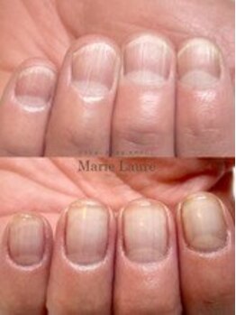 マリーロール 梅田店(Marie Laure)/自爪育成/深爪矯正/ネイルケア