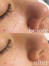 マドンナリリー 恵比寿店(Madonna Lily)/プレミアム顔脱毛★